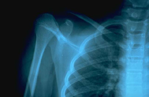 Radiograf�a de hombro